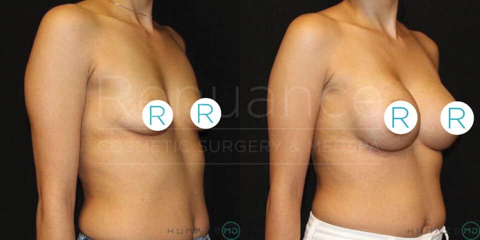 Before and after side-by-side images of a person who has undergone breast augmentation surgery. The left image shows a side view of the person before surgery, and the right image shows the same side view after surgery with visibly larger breasts. The person's face is not visible in either image, and white circles with the letter "R" cover the person's nipples in both photos. The background is black, and the watermark "Rogance COSMETIC SURGERY & MEDSPA" is visible in the center
