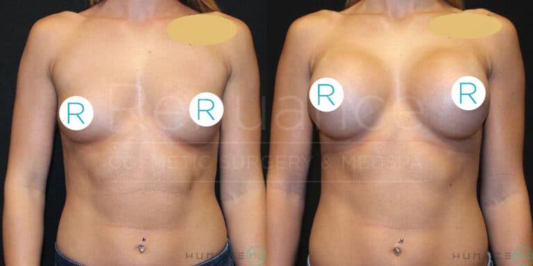 Side-by-side comparison image showing the upper body of a woman before and after breast augmentation surgery. The left side illustrates the "before" image with smaller breasts, while the right side displays the "after" image with larger breasts. The woman has a belly button piercing, and her face is not visible in either image. Both images have large "R" stickers covering the nipples for modesty, and there is a watermark in the center of the image with text that is partially visible.