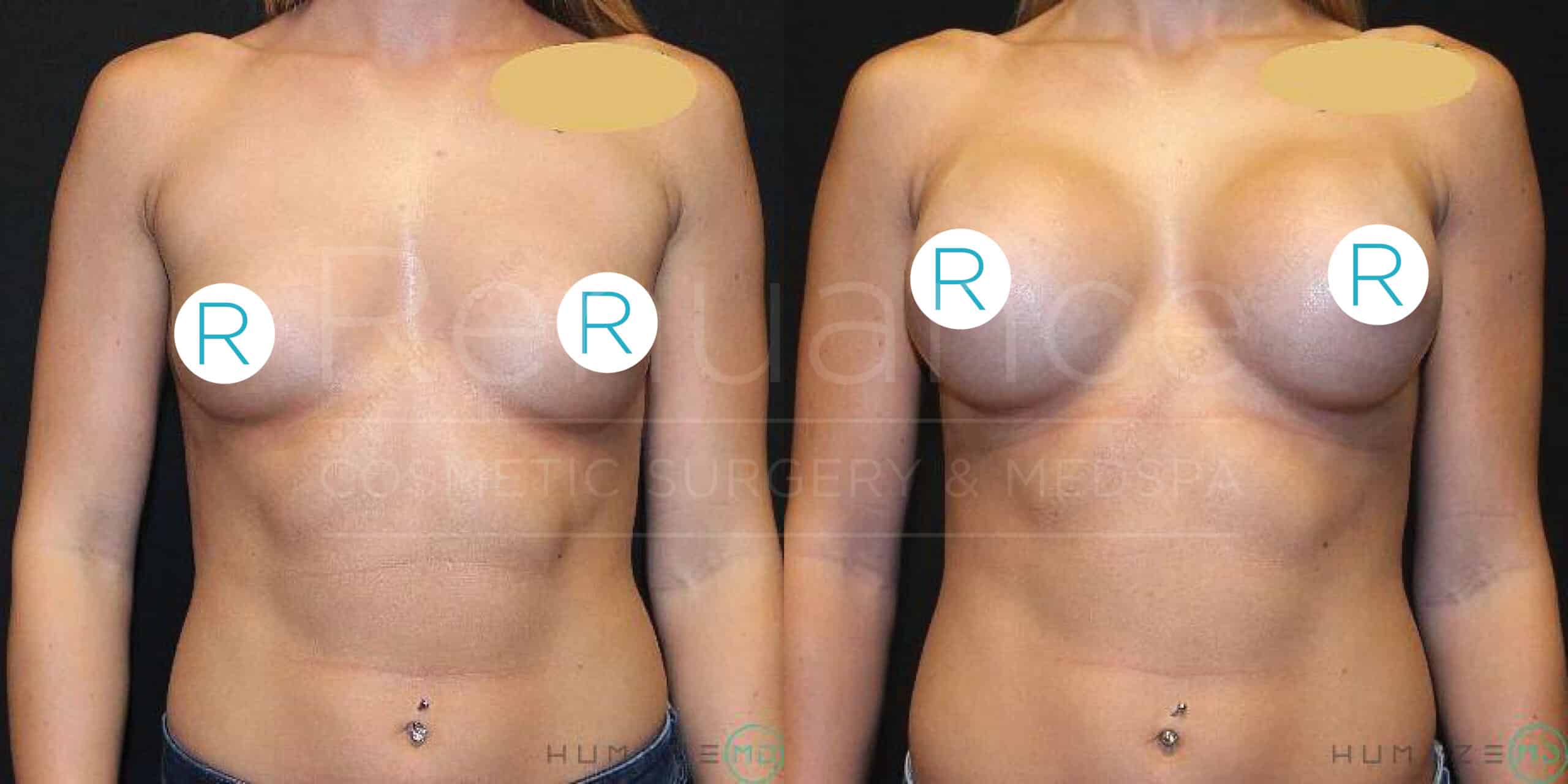 Side-by-side comparison image showing the upper body of a woman before and after breast augmentation surgery. The left side illustrates the "before" image with smaller breasts, while the right side displays the "after" image with larger breasts. The woman has a belly button piercing, and her face is not visible in either image. Both images have large "R" stickers covering the nipples for modesty, and there is a watermark in the center of the image with text that is partially visible.