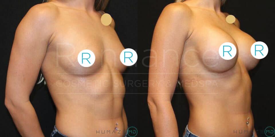 "Before and after side-by-side comparison of a woman’s torso showcasing the results of breast augmentation surgery. The left side displays the woman's natural breast size before the procedure, while the right side shows the increased breast size following the augmentation. Identifying features such as faces are obscured for privacy."
