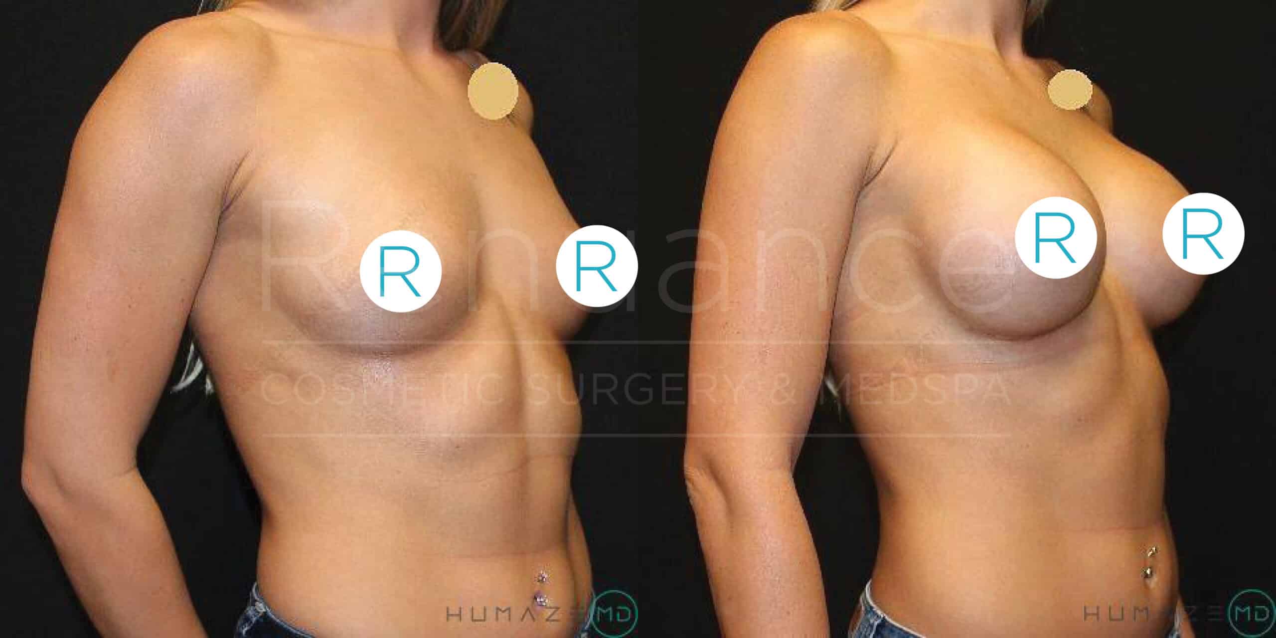"Before and after side-by-side comparison of a woman’s torso showcasing the results of breast augmentation surgery. The left side displays the woman's natural breast size before the procedure, while the right side shows the increased breast size following the augmentation. Identifying features such as faces are obscured for privacy."
