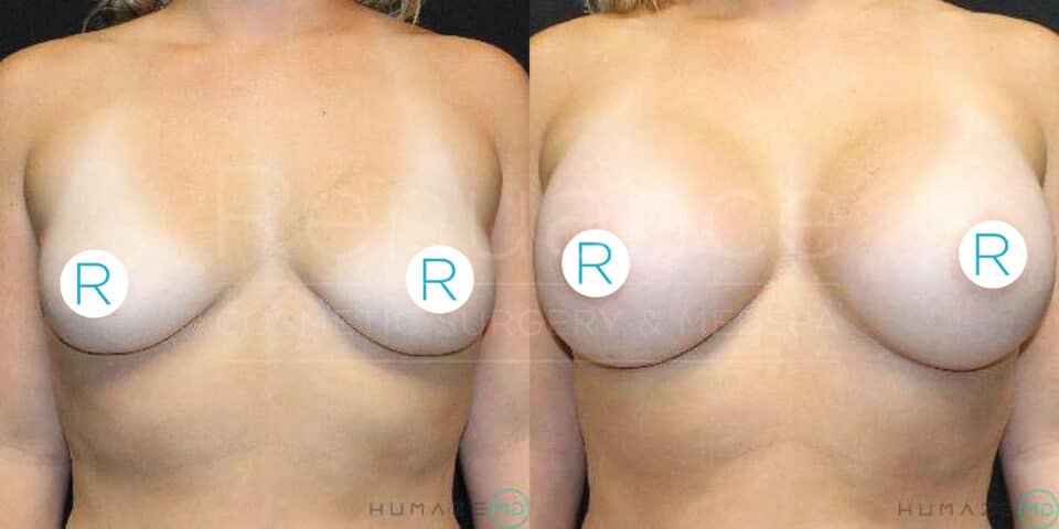 A before and after image showing the results of cosmetic breast surgery. The left side displays a woman's chest before the procedure, with smaller, natural breasts. The right side showcases the same woman after the surgery, with significantly larger and fuller breasts. The background appears to be a clinical setting. The image has the text "Resilience Cosmetic Surgery & Medical Spa" faintly visible across both sides.