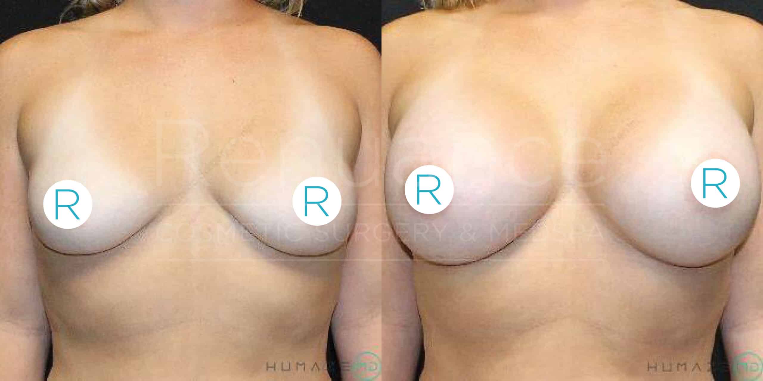 A before and after image showing the results of cosmetic breast surgery. The left side displays a woman's chest before the procedure, with smaller, natural breasts. The right side showcases the same woman after the surgery, with significantly larger and fuller breasts. The background appears to be a clinical setting. The image has the text "Resilience Cosmetic Surgery & Medical Spa" faintly visible across both sides.