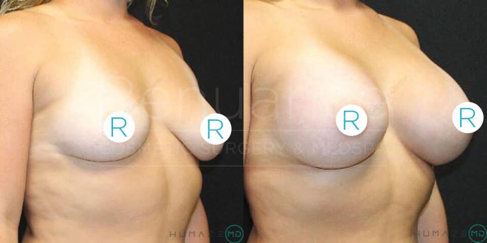 Side-by-side comparison showing a woman's chest before and after breast augmentation surgery. The left image displays her natural breasts, while the right image shows her augmented breasts. Both images are watermarked with text and logos.