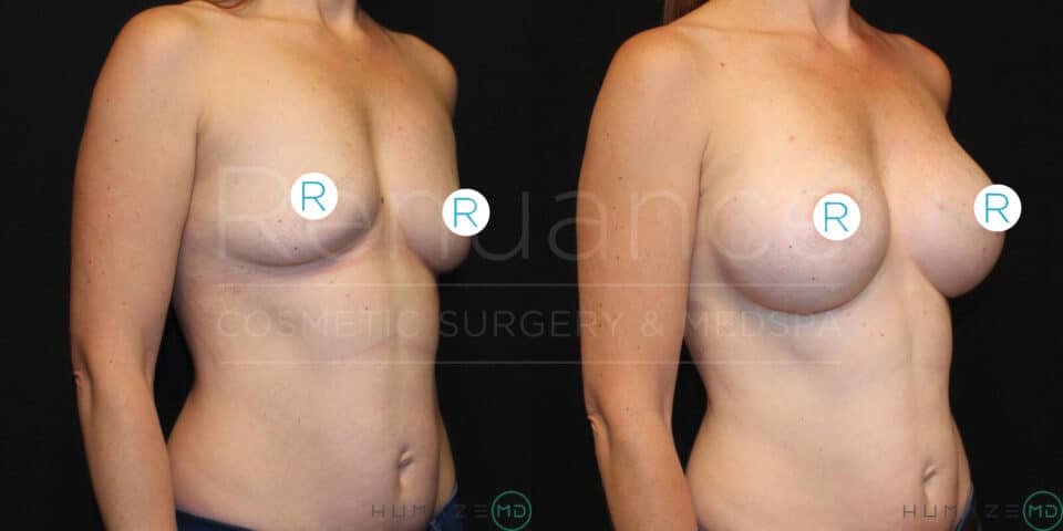 Side-by-side before and after images of a woman showing the results of breast augmentation surgery. The left image shows the woman before surgery with smaller breasts, while the right image shows the woman after surgery with noticeably larger breasts. Both images are taken from the side. The background is black. Letters "R" are visible on both images, probably indicating the right side.