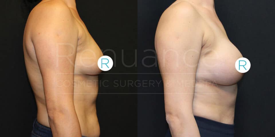 Side-by-side before and after images of a person's upper torso. The left image shows the person's torso before a procedure, and the right image shows significant changes in the chest area after a procedure. The individual is posing against a black background in both images, with a noticeable difference in the breast size and shape. Both images have a circular indicator with the letter "R" on it, and there is text across the images that appears to be related to cosmetic surgery.