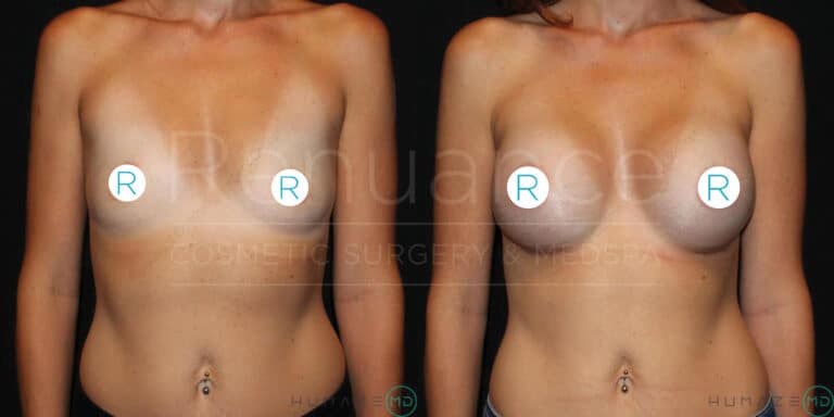A before-and-after photo of a person showing the front view of their torso, demonstrating the results of a cosmetic breast procedure. The before image on the left shows the breasts prior to the procedure, while the after image on the right shows the enhanced and reshaped breasts post-procedure. Both images are labeled with the letter "R" on each breast. The background appears to be a dark, neutral color.