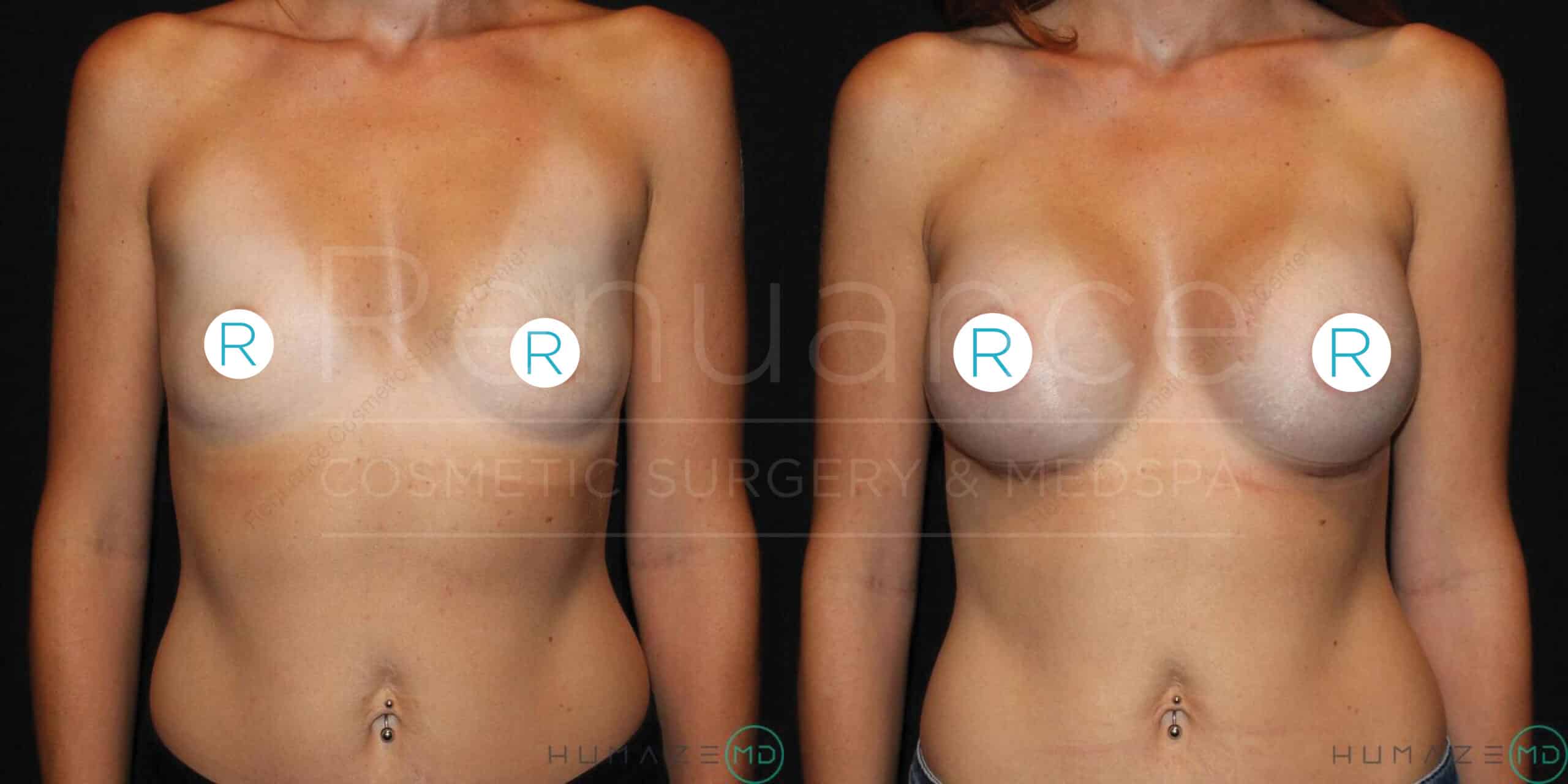 A before-and-after photo of a person showing the front view of their torso, demonstrating the results of a cosmetic breast procedure. The before image on the left shows the breasts prior to the procedure, while the after image on the right shows the enhanced and reshaped breasts post-procedure. Both images are labeled with the letter "R" on each breast. The background appears to be a dark, neutral color.