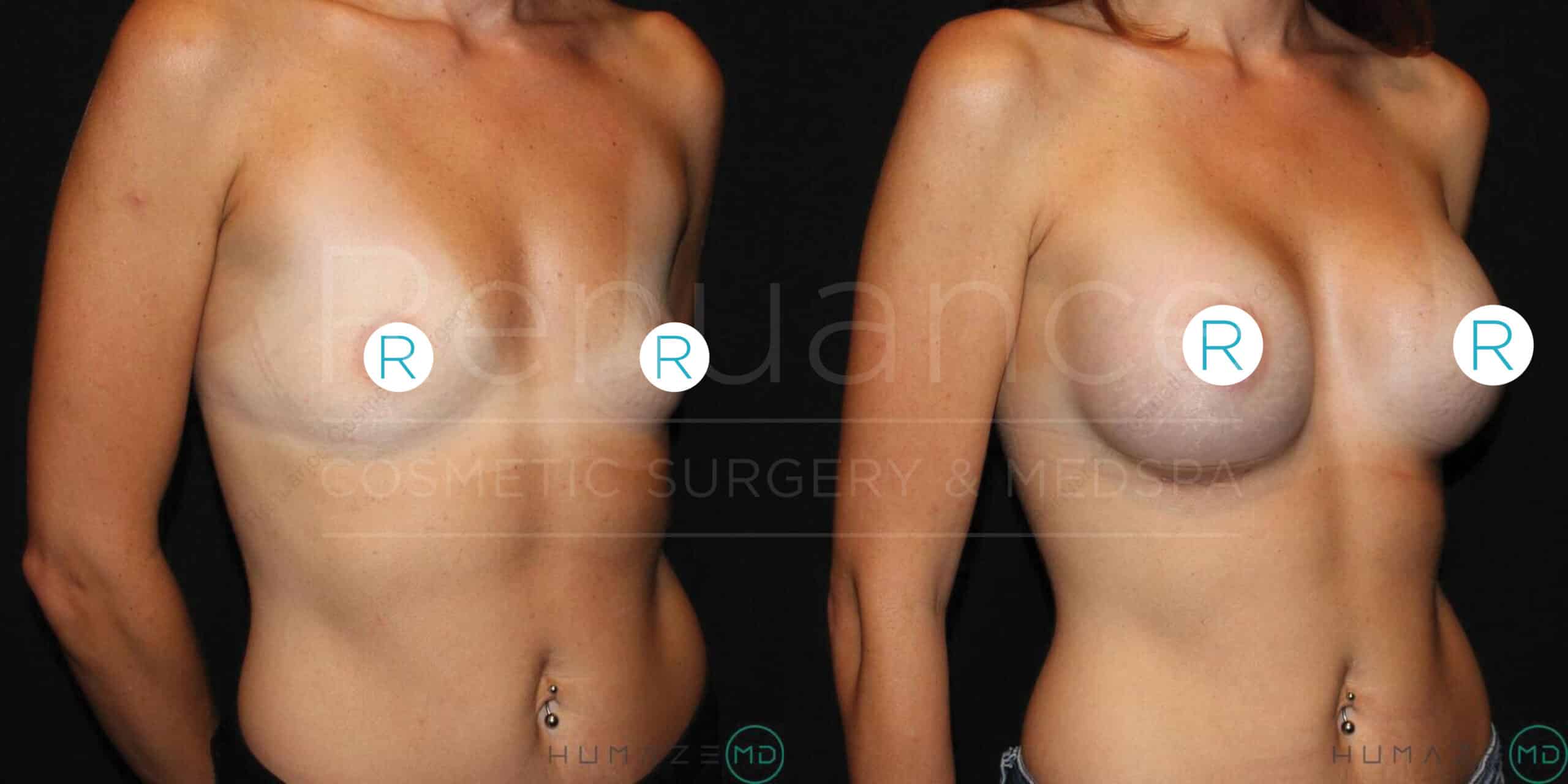 A before and after image showing the results of a breast augmentation procedure. On the left, a woman is seen with smaller, natural breasts and on the right, the same woman is seen with noticeably fuller and augmented breasts. Both images are taken from a front angle with the person standing topless. The background is dark, emphasizing the changes in the breast size and shape.