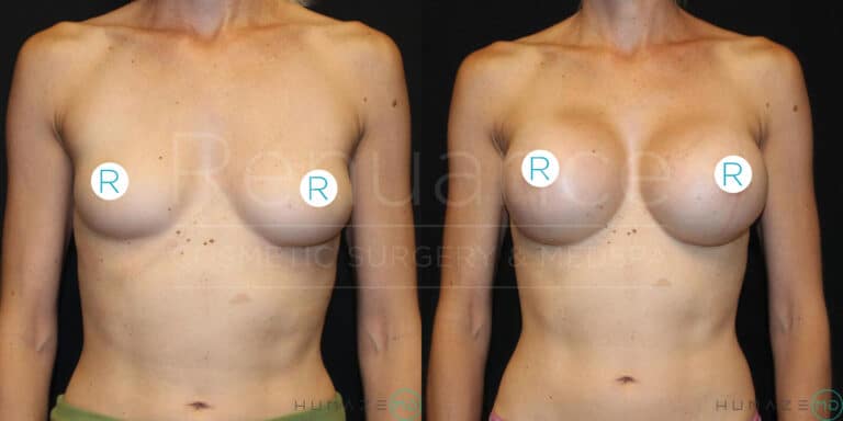"Comparison image of a woman's chest, shown before (left) and after (right) breast augmentation surgery. The left image displays smaller, natural breasts with surgical markings, while the right image shows larger, augmented breasts with improved fullness and contour."