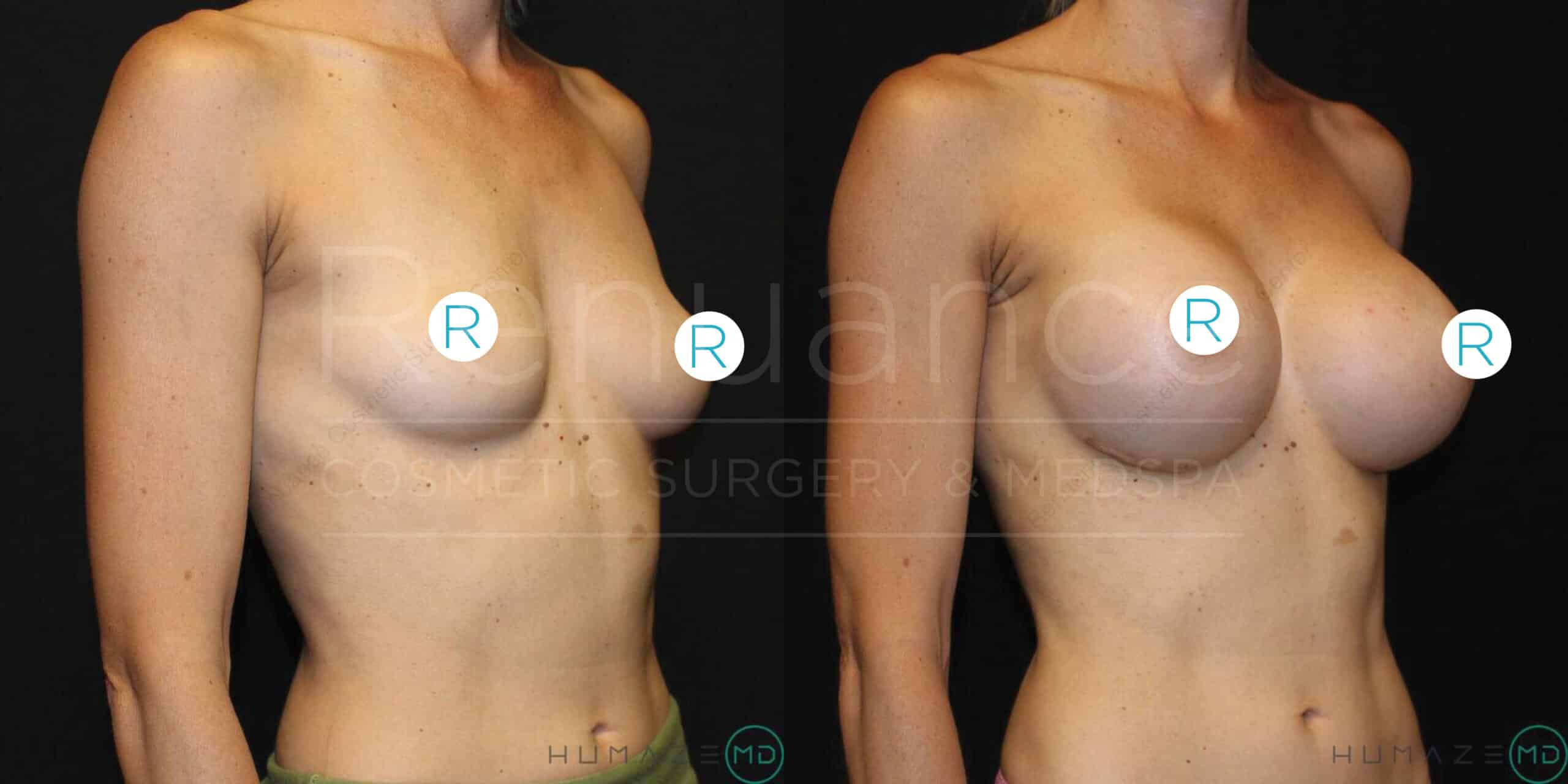 Before and after images of a woman's torso, illustrating the results of breast augmentation surgery. The left image shows the woman with smaller breasts, while the right image shows the woman with larger, fuller breasts post-surgery. Both images are taken from a side angle.