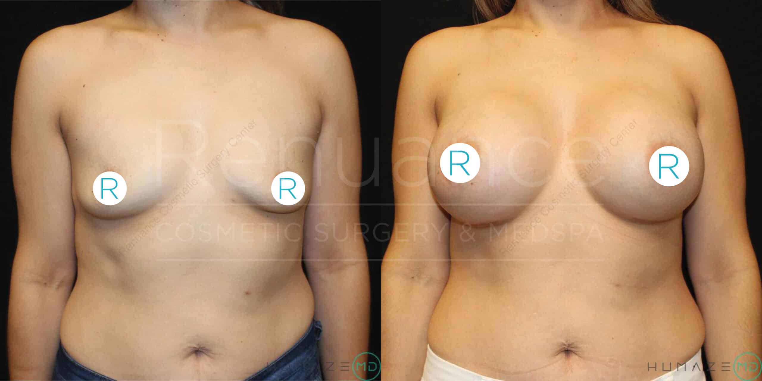 A side-by-side comparison image showing the upper torso of a woman before and after a cosmetic breast procedure. The left side (before) shows smaller, sagging breasts, while the right side (after) displays larger, uplifted breasts with increased volume. The letters "R" are placed over each breast in both images. In the background, faint text reads "Rejuve Cosmetic Surgery & Medspa".