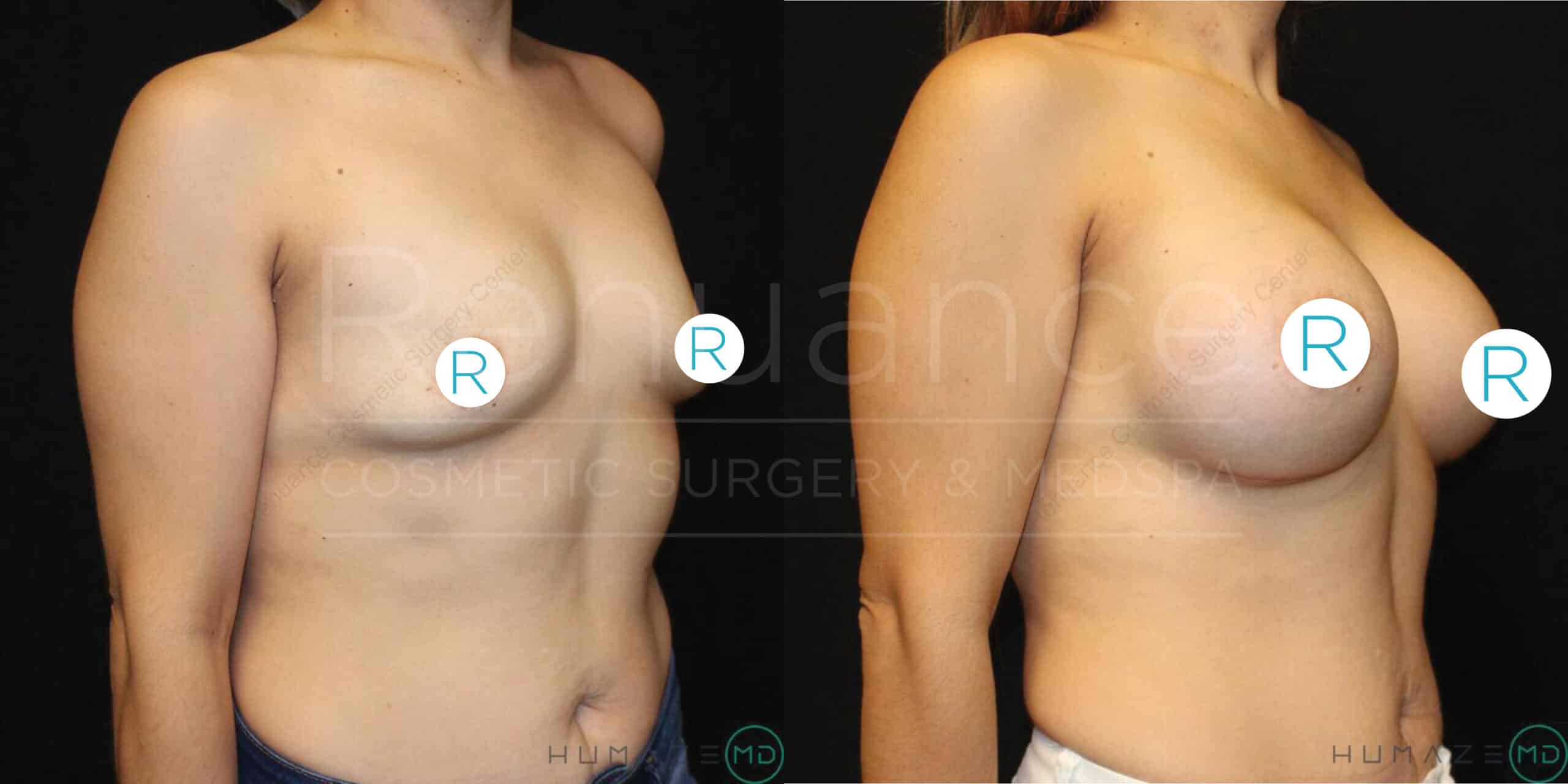 Before and after side view comparison of a person's upper body, showing the results of a breast augmentation surgery. The left image displays the individual before the procedure, and the right image shows the enhanced breast size and shape post-surgery. Both images have marks indicating right from left.