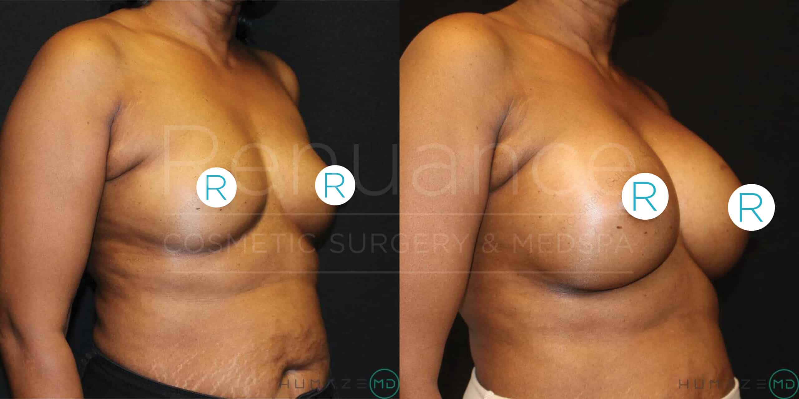 Comparison showing the left profile view of a woman's torso before and after a cosmetic breast enhancement procedure. The left image depicts the torso prior to surgery, while the right image shows the noticeable increase in breast size post-surgery.