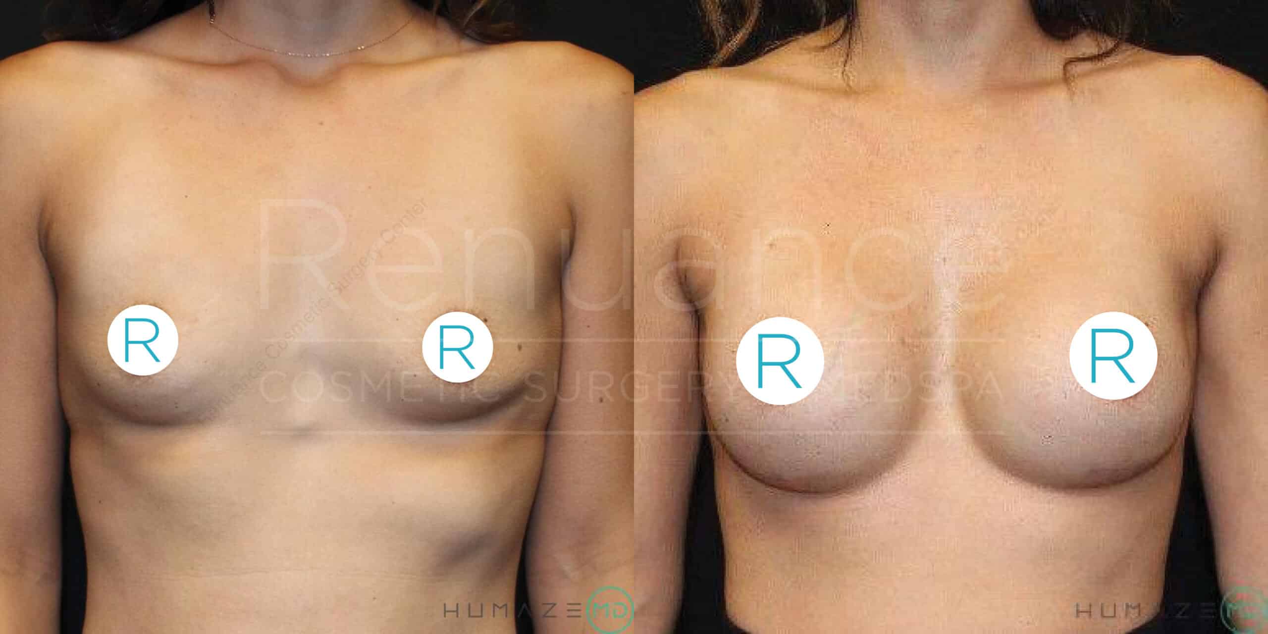 Before and after photo of a person who has undergone breast augmentation surgery. The left side shows the individual before the procedure with smaller breasts, and the right side shows the enhanced, larger breasts post-surgery. The nipples are covered with "R" labeled stickers in both images. The background is black.