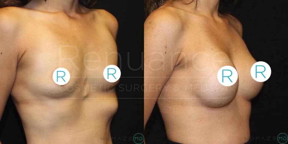 A side-by-side comparison of a woman's torso before and after breast augmentation surgery. The left image shows the pre-operative state with smaller breasts, while the right image shows a post-operative state with larger, fuller breasts. Both images focus on the torso from the upper ribcage to the waist and have a dark background.