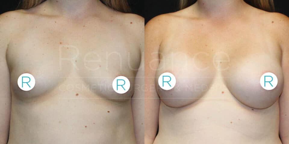 The image shows a before and after comparison of a woman's chest, illustrating the results of a breast augmentation surgery. In the before image, the woman's breasts appear smaller and less defined. In the after image, her breasts are larger and more rounded. The images are labeled with "R" stickers over the nipples, and the background is black. The text overlay reads, "Renuance Cosmetic Surgery Center."