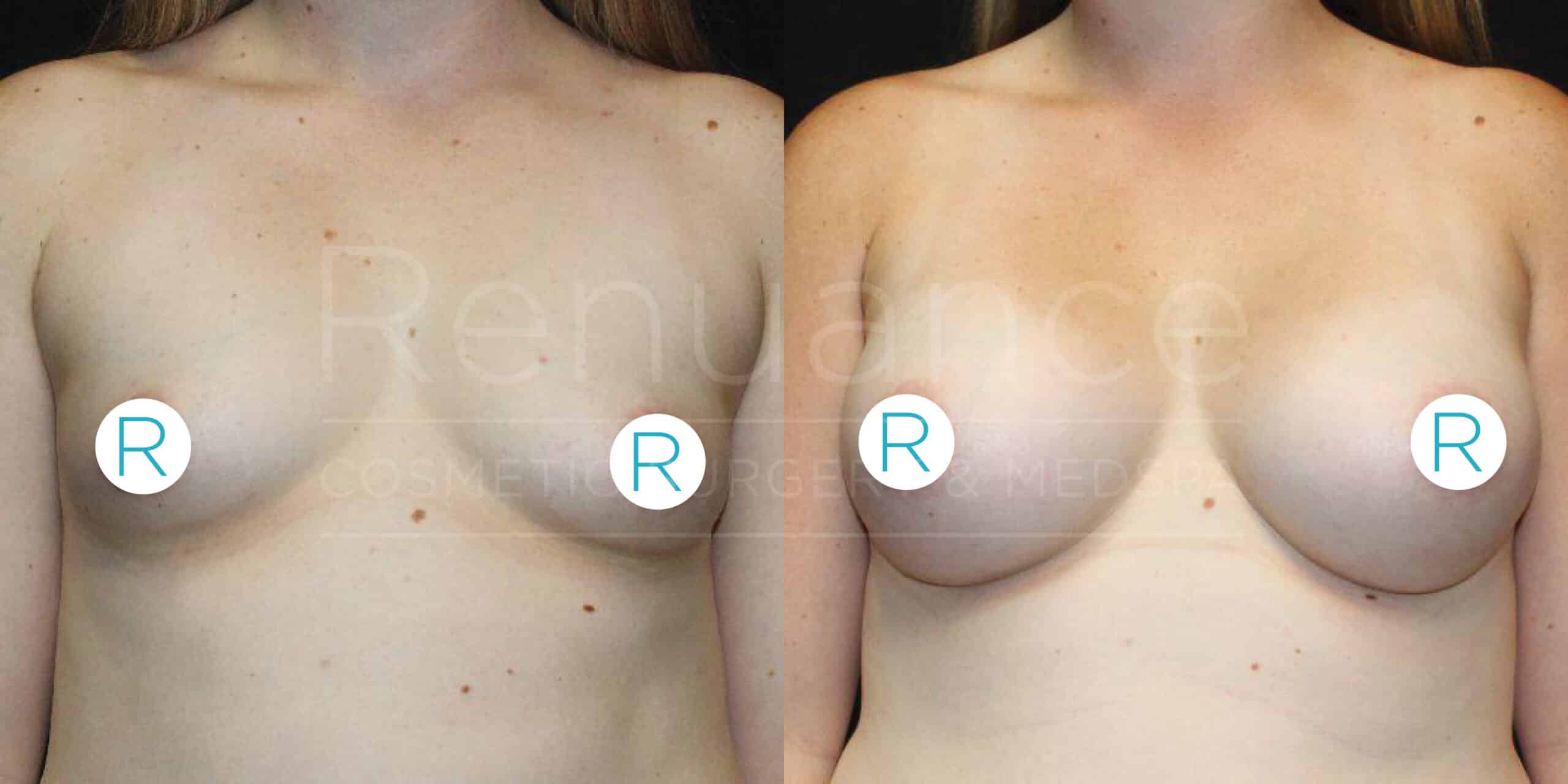 The image shows a before and after comparison of a woman's chest, illustrating the results of a breast augmentation surgery. In the before image, the woman's breasts appear smaller and less defined. In the after image, her breasts are larger and more rounded. The images are labeled with "R" stickers over the nipples, and the background is black. The text overlay reads, "Renuance Cosmetic Surgery Center."