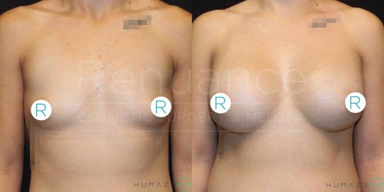 Before and after comparison of a person's chest, showing the results of cosmetic breast augmentation surgery. The left image represents the "before" state, and the right image represents the "after" state. The images are labeled with "R" on the chest area.
