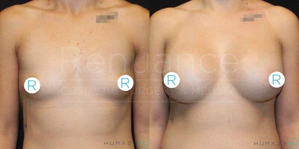 Before and after comparison of a person's chest, showing the results of cosmetic breast augmentation surgery. The left image represents the "before" state, and the right image represents the "after" state. The images are labeled with "R" on the chest area.