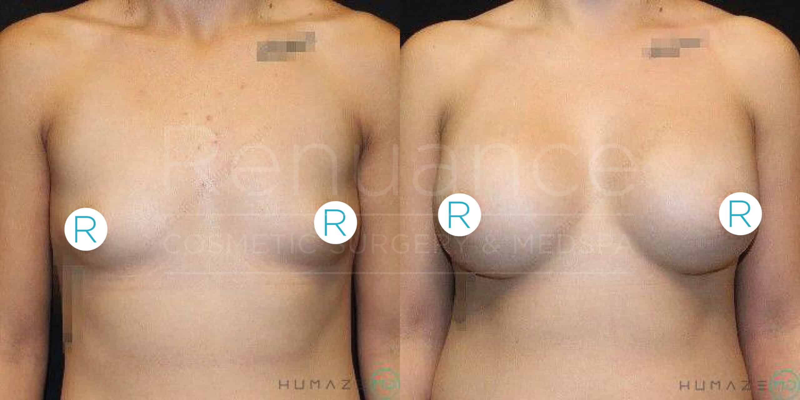 Before and after comparison of a person's chest, showing the results of cosmetic breast augmentation surgery. The left image represents the "before" state, and the right image represents the "after" state. The images are labeled with "R" on the chest area.