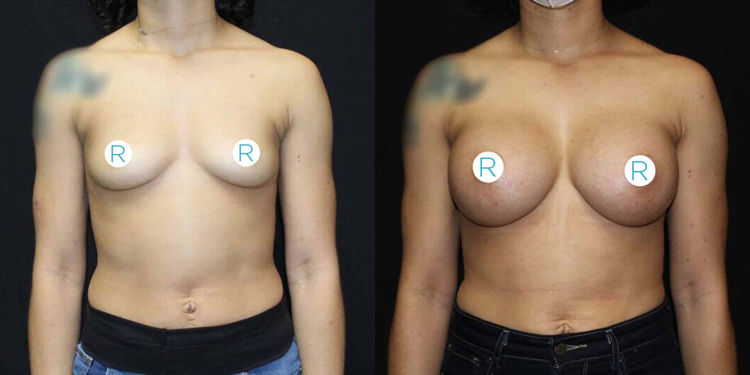 Two side-by-side images of a person’s upper torso. The image on the left shows the person before a breast augmentation procedure, with smaller breasts. The image on the right shows the same person after the procedure, with noticeably larger breasts. Both images have stickers with the letter 'R' covering the nipples. The background in both images is black.