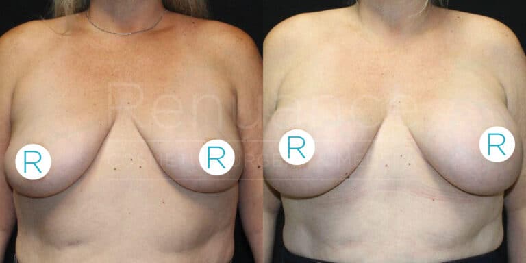 Two side-by-side images showing a woman's upper torso before and after breast surgery. Both images display her from the front, with indicators labeled "R" on her breasts. The "before" image on the left shows her breasts with noticeable sagging, while the "after" image on the right shows her breasts lifted and reshaped. The woman's face is not visible in either image.
