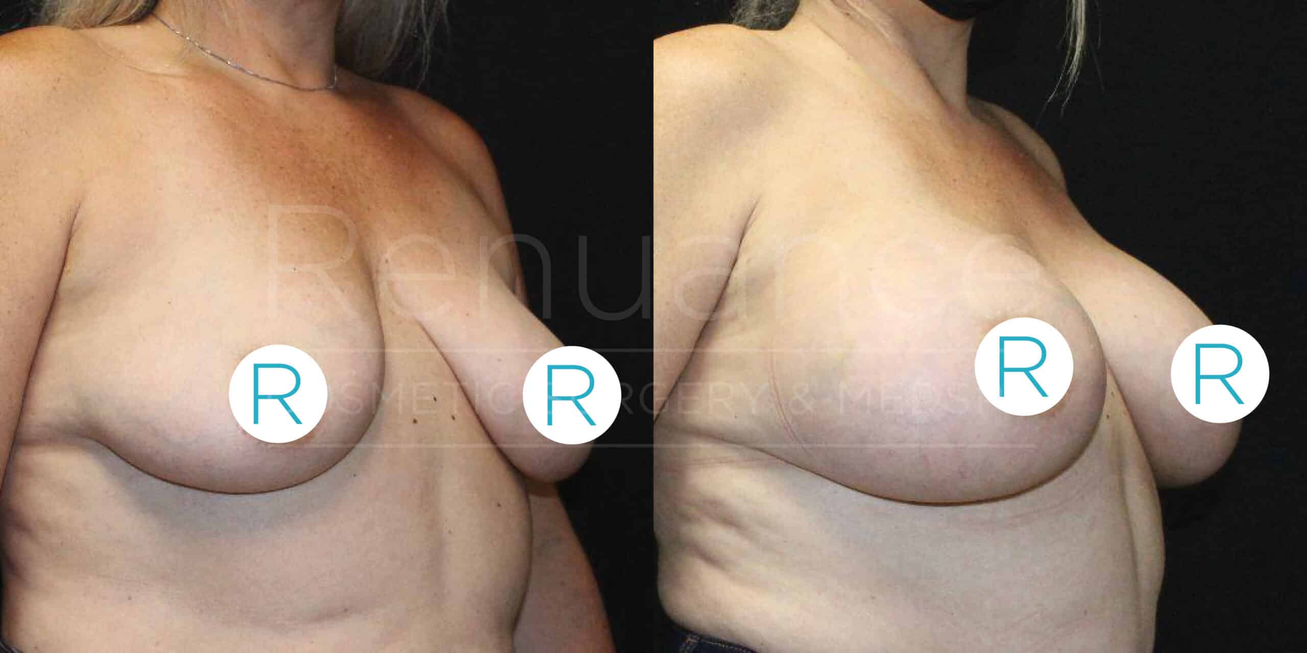 Side-by-side comparison of two images showing a person's chest area. The left image shows the chest before a surgical procedure, with breasts that appear lower and less firm. The right image shows the chest after the procedure, with the breasts appearing fuller, higher, and more lifted. Circular labels marked with "R" cover the nipples in both images to maintain privacy.