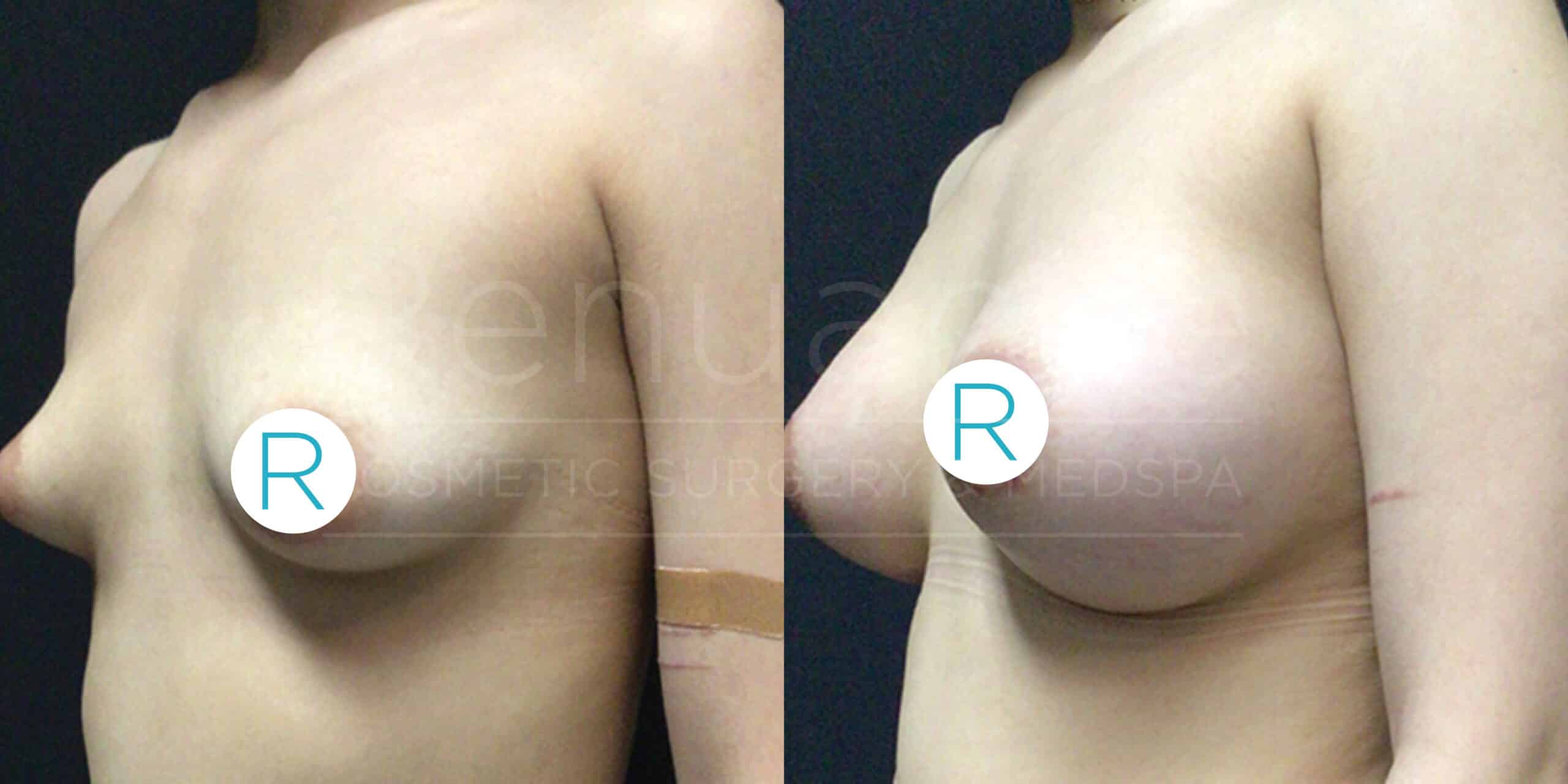 A side-by-side comparison photo showing the chest area of a person before (left) and after (right) breast augmentation surgery. The left image shows smaller, less pronounced breasts, while the right image shows larger, fuller breasts. Prominent "R" labels are placed over the nipples for privacy.