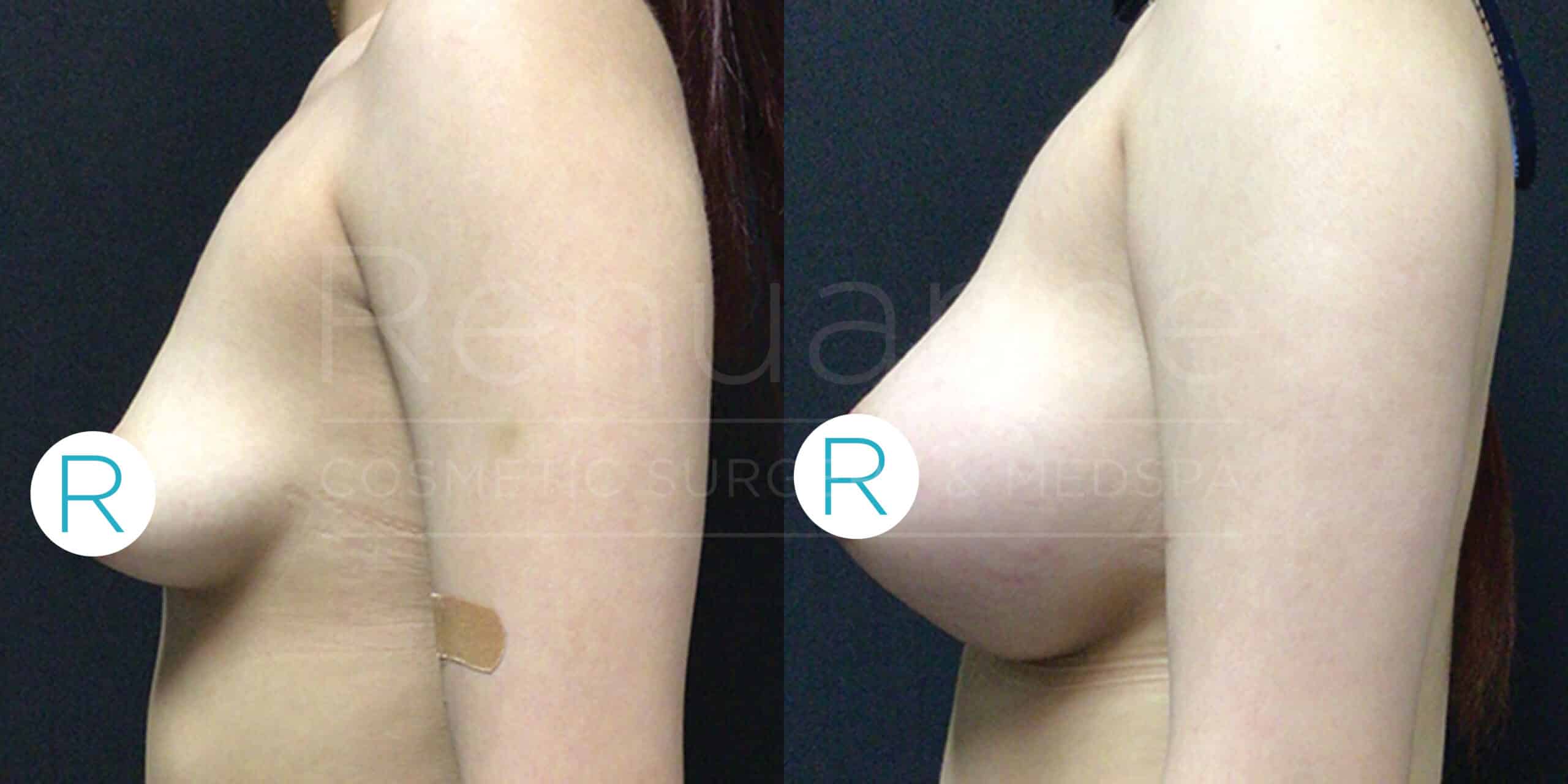 Side-by-side comparison of a woman's torso before and after a cosmetic breast augmentation procedure. The left side shows the body with smaller breasts, while the right side depicts larger, enhanced breasts after surgery. Both images are set against a black background, with the letter "R" indicating the right side in each image. The woman in the image is wearing no visible clothing.