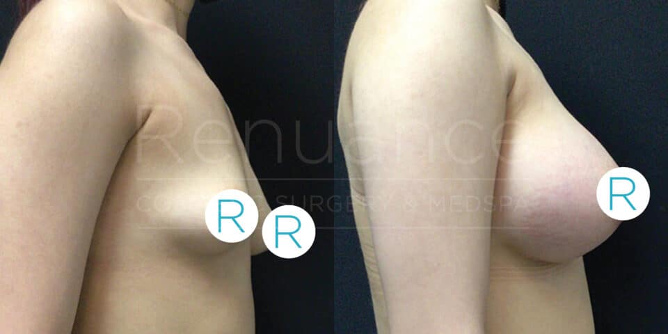 Before and after side profile images of a person's torso, demonstrating the results of a breast augmentation procedure. The left image shows a smaller breast size, while the right image shows significantly larger and more uplifted breasts. Both images have "R" symbols on the breasts.