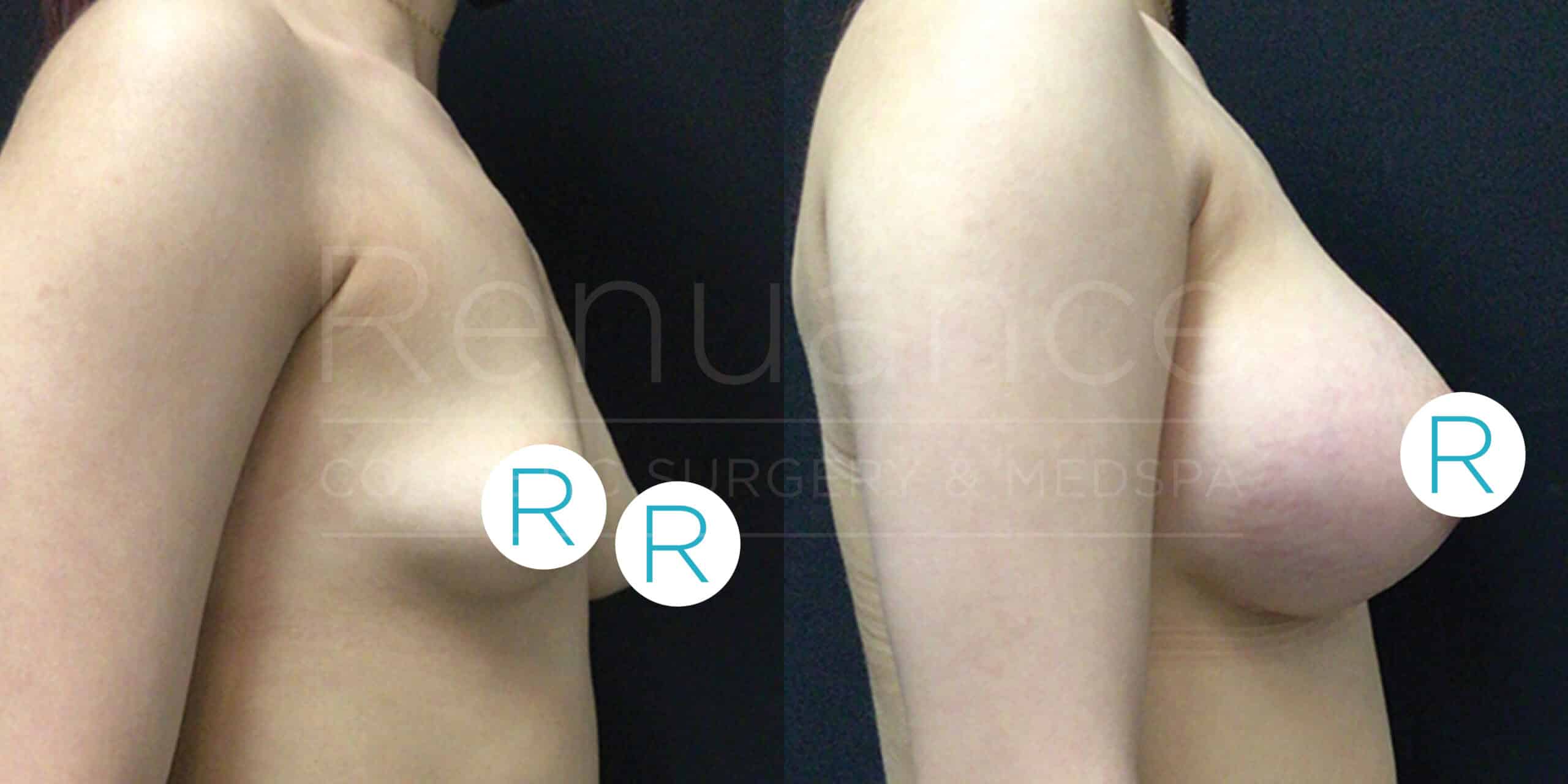 Before and after side profile images of a person's torso, demonstrating the results of a breast augmentation procedure. The left image shows a smaller breast size, while the right image shows significantly larger and more uplifted breasts. Both images have "R" symbols on the breasts.