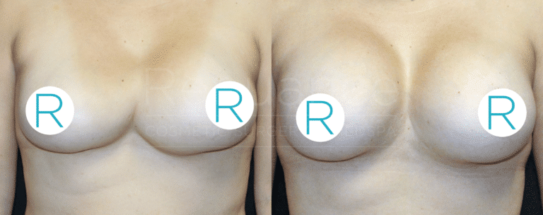 A side-by-side comparison of a person's torso showing the results before and after breast augmentation surgery. The left side shows the breasts before the surgery, while the right side shows the enhanced breasts after the procedure. Both images have circular labels with the letter "R" placed over the nipples for privacy.