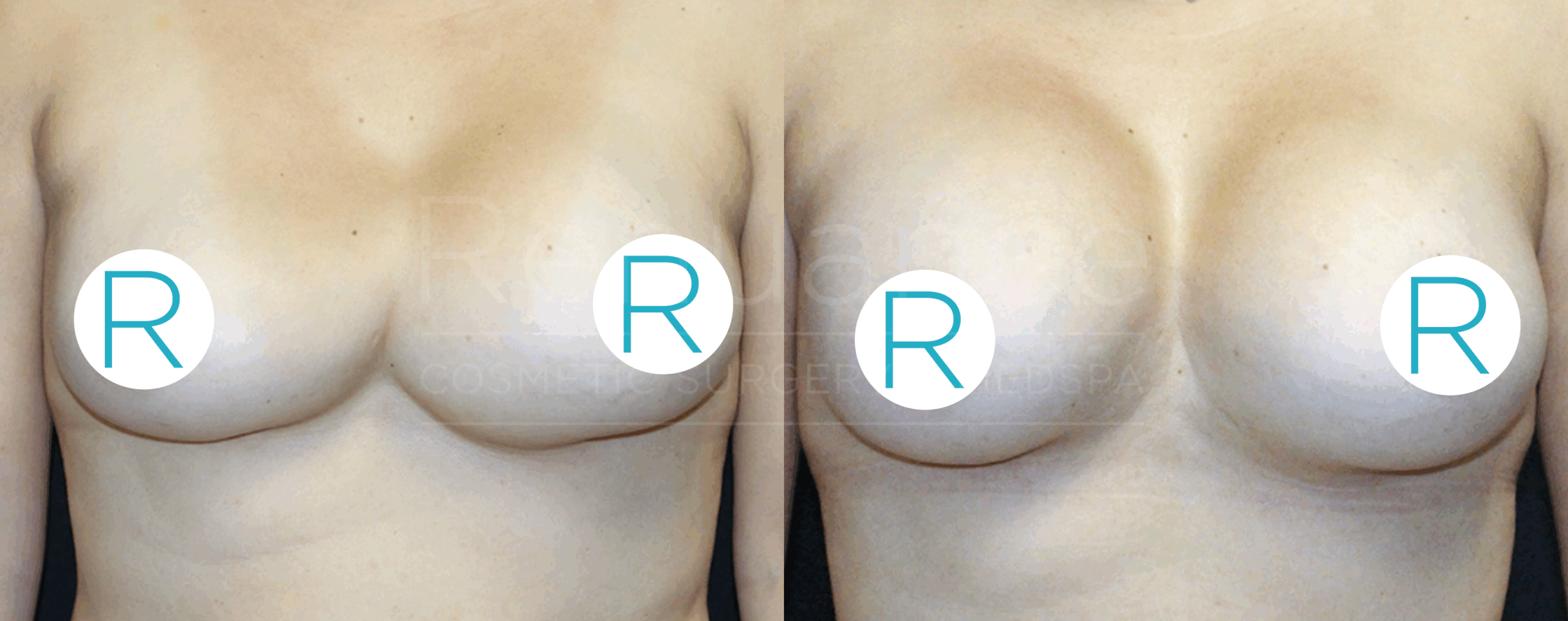 A side-by-side comparison of a person's torso showing the results before and after breast augmentation surgery. The left side shows the breasts before the surgery, while the right side shows the enhanced breasts after the procedure. Both images have circular labels with the letter "R" placed over the nipples for privacy.