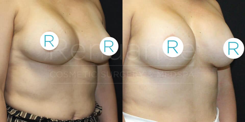 Side-by-side before and after images of a person's upper torso showing the results of cosmetic surgery. The left image depicts the person's torso before the procedure, and the right image shows the same person after the procedure with noticeable changes in breast size and contour. Both images have a label marked "R" placed over the nipples to cover them. The background is black, and there's a faint watermark overlay in the center with indistinct text.