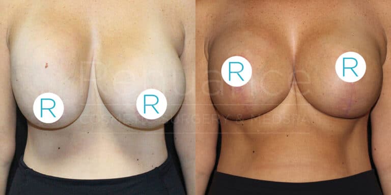 Before and after comparison of a person who has undergone breast augmentation surgery. The left side displays pre-surgery, with natural breasts and less symmetry. The right side shows post-surgery with fuller and more symmetrical breasts.
