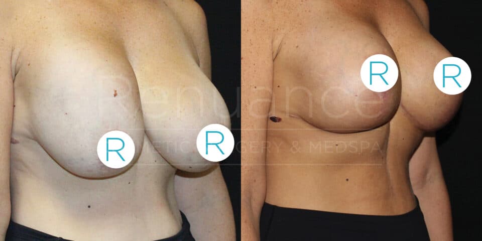 Before and after comparison of a person's chest, showing the results of breast reduction surgery. Both images are labeled with a white circle containing the letter "R" for right side, displaying the significant reduction in breast size and improved positioning. The individual's skin tone has not significantly changed between the two images.