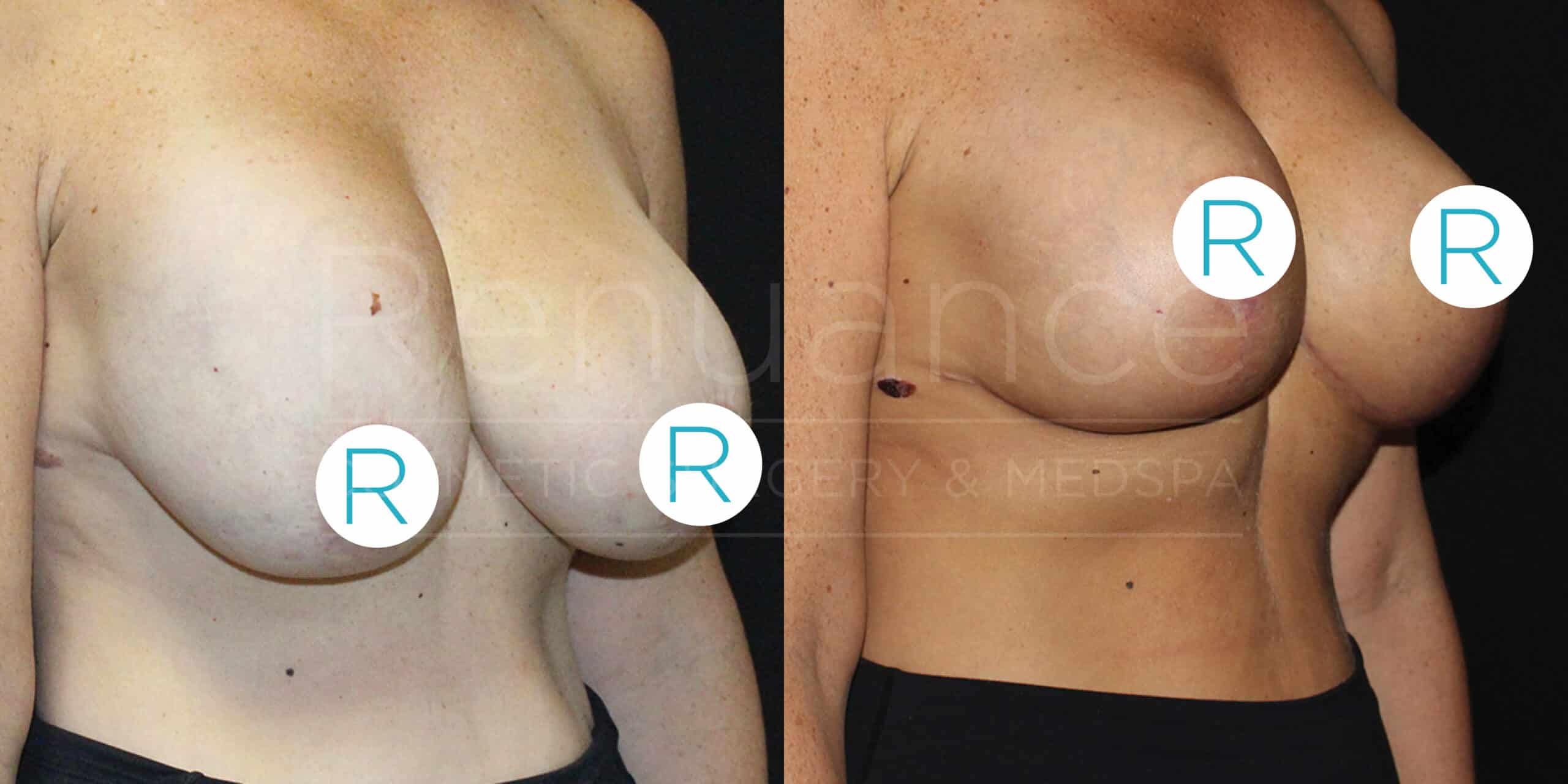 Before and after comparison of a person's chest, showing the results of breast reduction surgery. Both images are labeled with a white circle containing the letter "R" for right side, displaying the significant reduction in breast size and improved positioning. The individual's skin tone has not significantly changed between the two images.