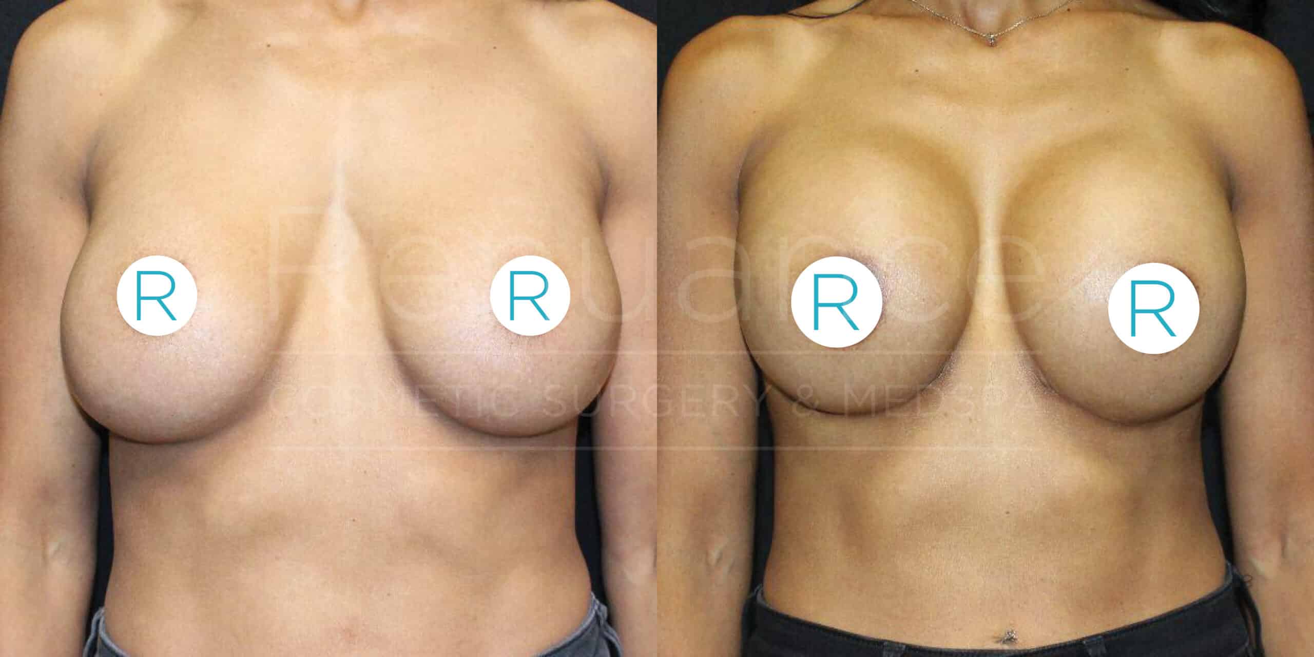 A before-and-after image showing the results of a breast augmentation procedure. In the first part of the image, a person’s chest is shown before the surgery with smaller, natural breasts. In the second part, the same person’s chest is shown after the surgery with larger, fuller breasts. Both images have circular labels with the letter "R" covering the nipples for modesty.