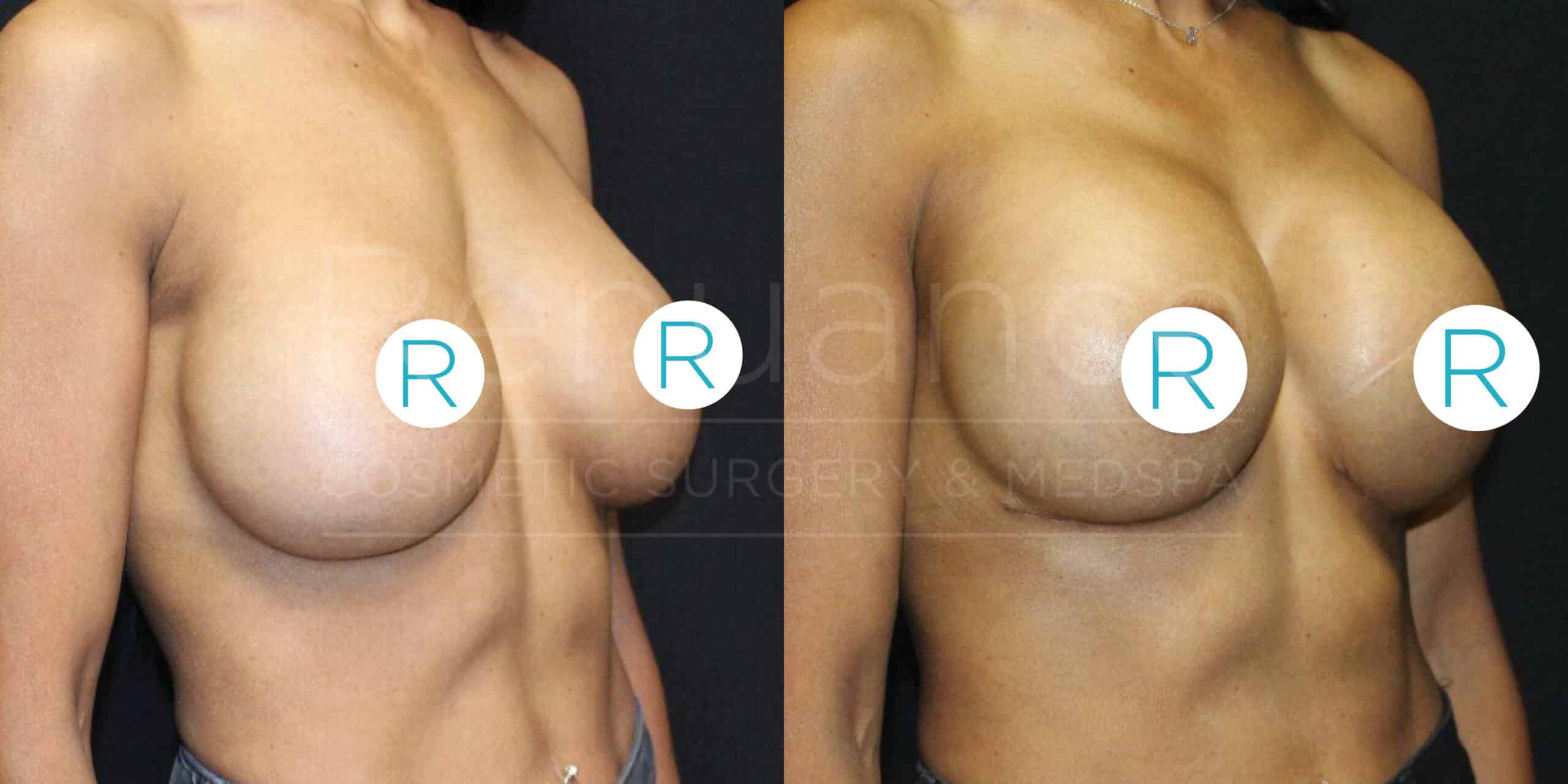 Side-by-side comparison of a woman's bust before and after cosmetic breast surgery. The left image shows the "before" state, and the right image shows the "after" state, indicating enhanced breast size and shape.