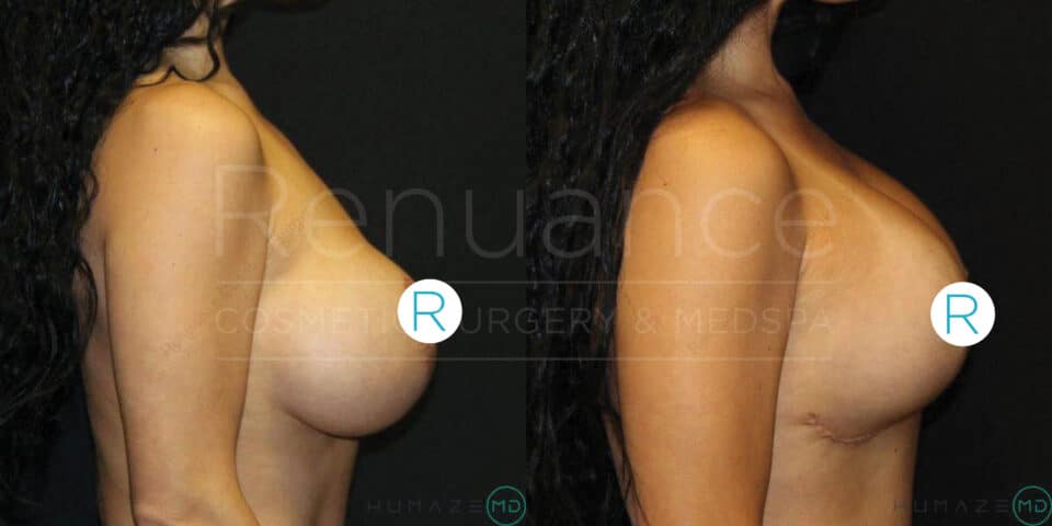 A side-by-side comparison image showing before and after views of breast augmentation surgery on a woman. The "before" view on the left depicts smaller natural breasts, while the "after" view on the right shows larger enhanced breasts. The woman's head and neck are not visible in the image. The background is black and there is a faint overlay of text reading "Renuance Cosmetic Surgery & Medspa". The letter "R" encircled is visible on both images.