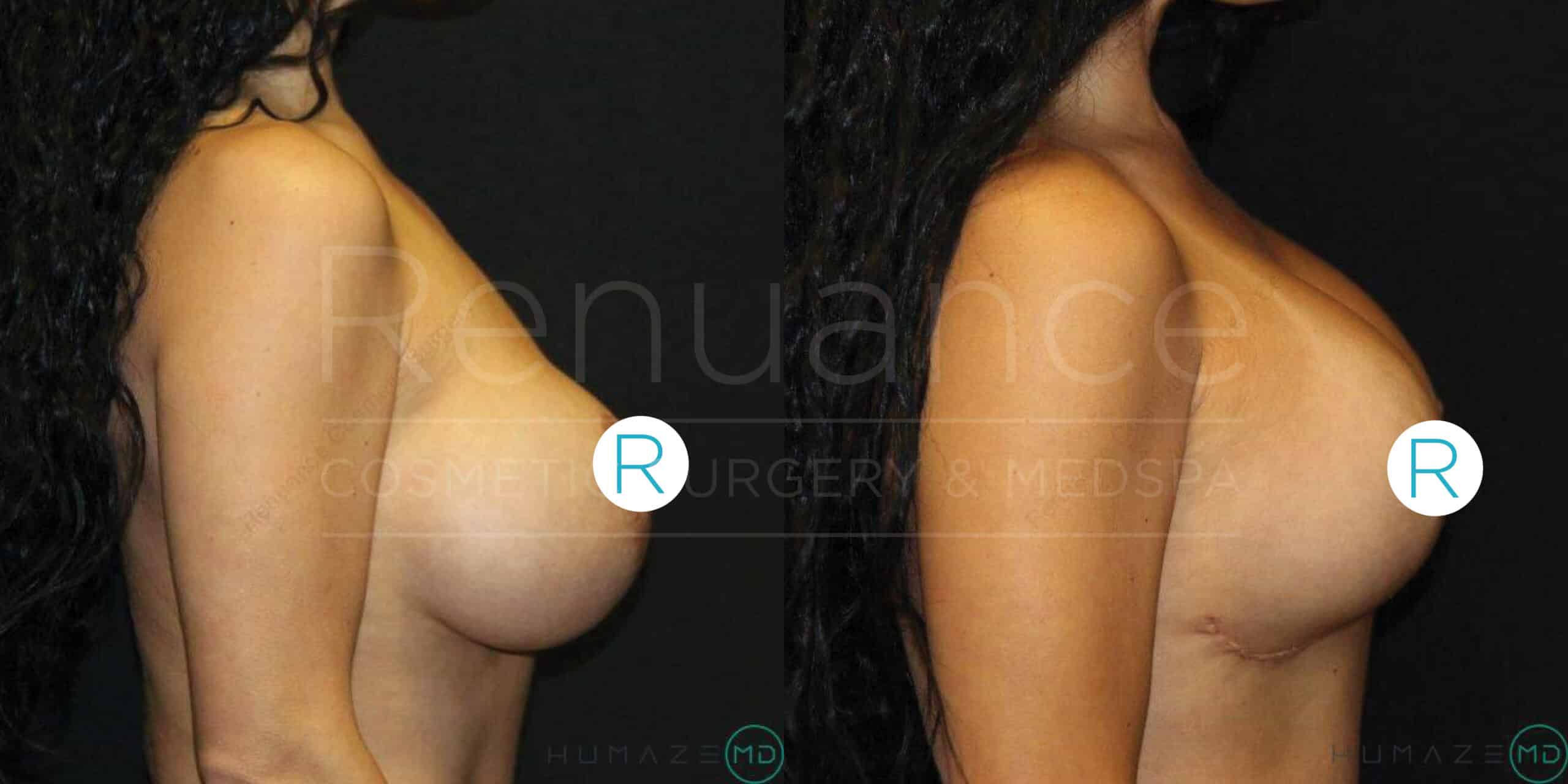 A side-by-side comparison image showing before and after views of breast augmentation surgery on a woman. The "before" view on the left depicts smaller natural breasts, while the "after" view on the right shows larger enhanced breasts. The woman's head and neck are not visible in the image. The background is black and there is a faint overlay of text reading "Renuance Cosmetic Surgery & Medspa". The letter "R" encircled is visible on both images.