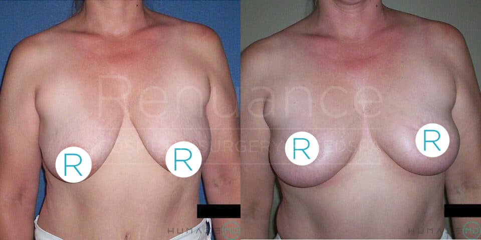 A side-by-side comparison of a woman's chest before and after breast reconstruction surgery. The image on the left shows the chest before the procedure, while the image on the right shows the results after the surgery. Both images are labeled with "R" on the chest.