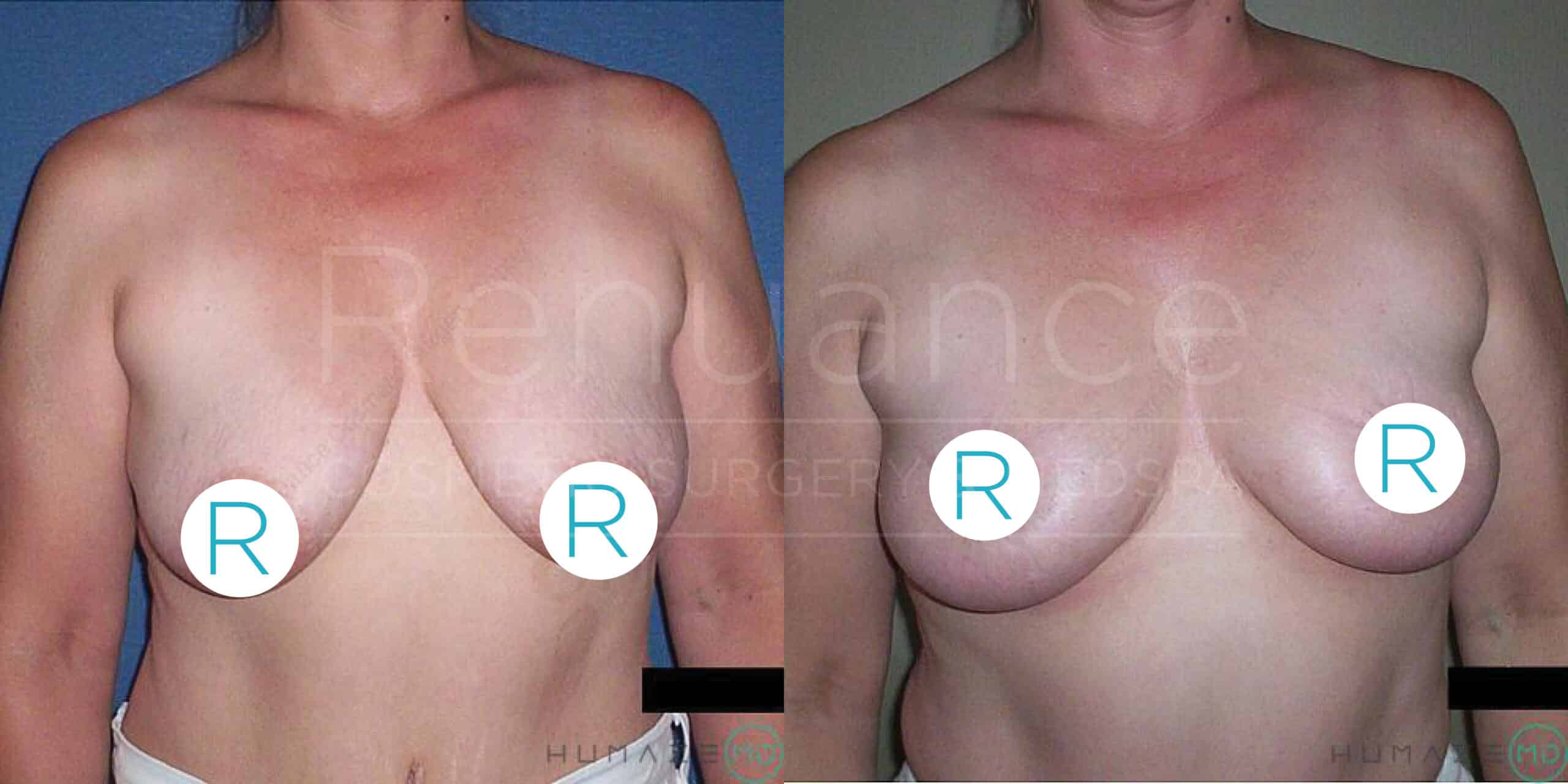 A side-by-side comparison of a woman's chest before and after breast reconstruction surgery. The image on the left shows the chest before the procedure, while the image on the right shows the results after the surgery. Both images are labeled with "R" on the chest.