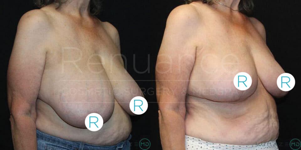 Two side-by-side images of a woman's chest and upper body, showing before and after results of a cosmetic procedure. In the "before" image on the left, the woman's breasts appear larger and sagging. In the "after" image on the right, her breasts appear smaller and lifted. Both images are labeled with the letter "R" in circles, strategically placed over the nipples for modesty. The background is black.