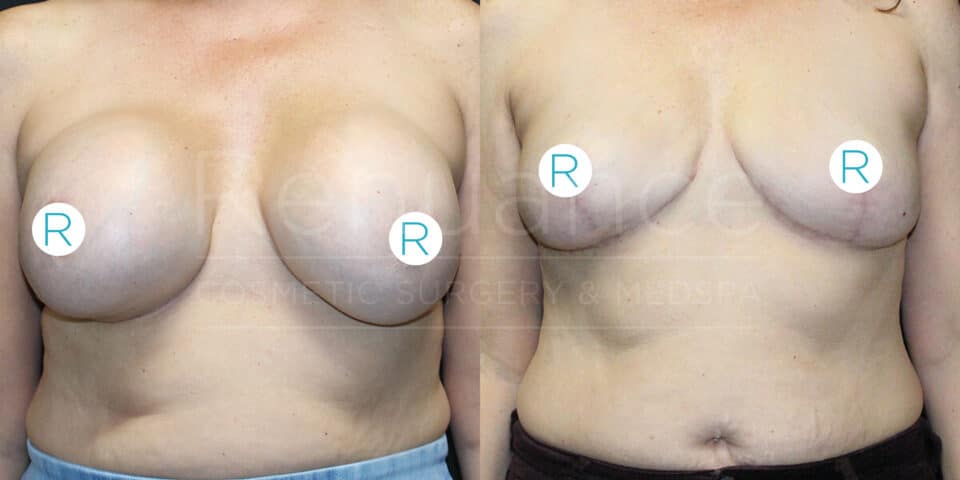The image shows side-by-side before and after photos of a patient who has undergone breast surgery. In the "before" image on the left, the patient has large, firm, rounded breasts with skin stretching. In the "after" image on the right, the breasts appear smaller, flatter, and more natural in shape. Both images have an "R" label on each breast for reference. The background features a watermark that appears to read "Resonance Cosmetic Surgery & Medspa." The patient's