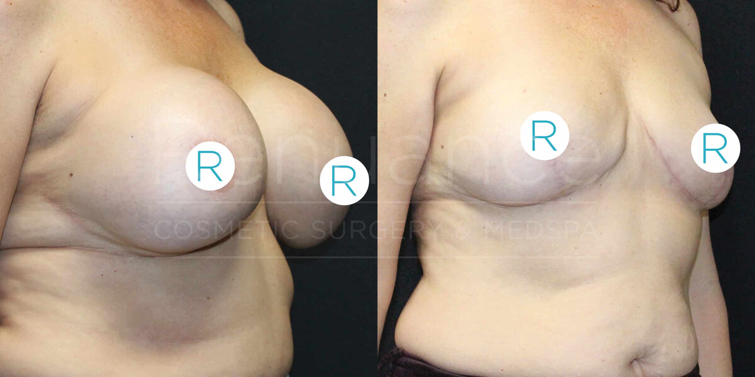 A side-by-side comparison image of the upper body of a person before and after breast reduction surgery. The left image shows the person's chest before the procedure, with larger, sagging breasts. The right image shows the same person post-surgery, with noticeably smaller and lifted breasts. Both images are marked with a circular label containing the letter "R" on each breast, likely indicating the right side in each photo. The background is black.