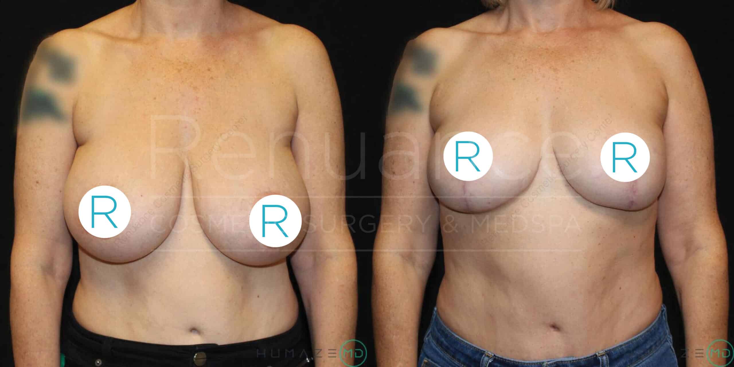 A before-and-after image depicts two women from the chest up, showcasing the results of a cosmetic breast procedure. The woman on the left has larger, sagging breasts, while the woman on the right appears post-surgery with lifted, smaller breasts. Both women have their nipples covered with circles marked with the letter 'R'. The text "Renuance Cosmetic Surgery & MedSpa" is faintly visible in the background.