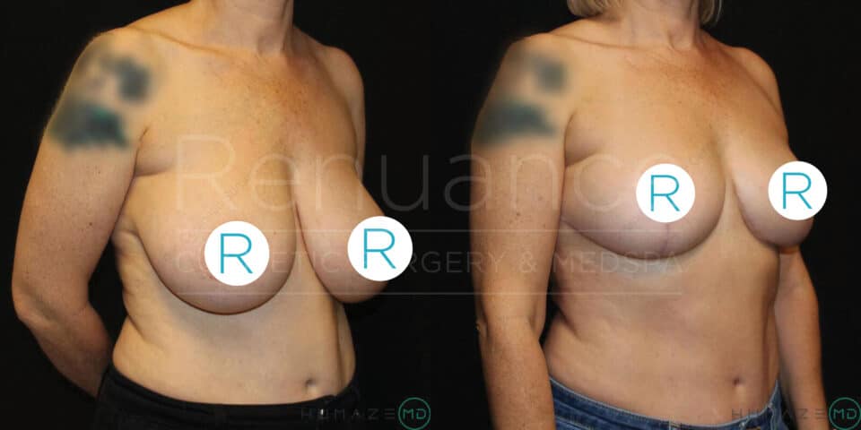 Before and after image of a woman who appears to have undergone breast surgery. The first image shows the woman's bare chest with breasts showing signs of sagging. The second image shows the same woman with fuller, uplifted breasts after surgery. She is standing in a similar pose in both images, with her arms at her sides. The background is black in both images. Both images have the woman's nipples covered with a "R" in a blue circle.
