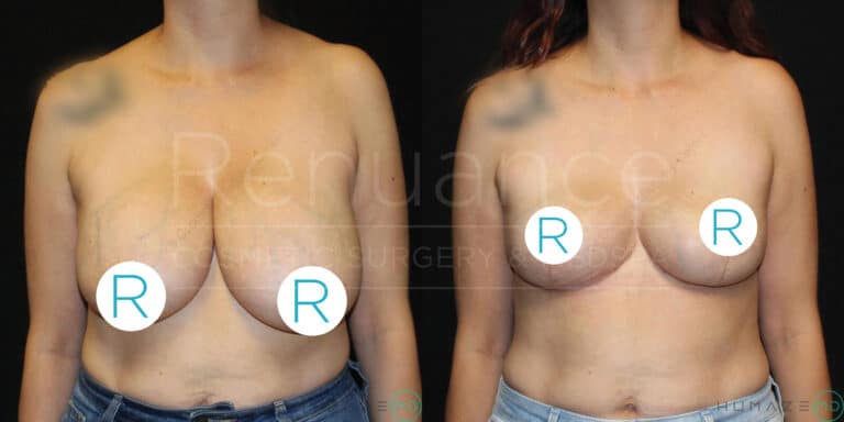 Side-by-side comparison of a person before and after undergoing breast reduction surgery. The left image shows the person prior to surgery, while the right image displays the results post-surgery. The person is standing facing forward in both images, against a dark background. Both images have stickers with the letter "R" covering the person's nipples.